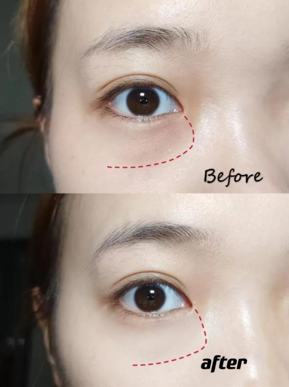 熬夜引起的泪沟黑眼圈能消失么,万年黑眼圈眼袋泪沟怎么遮瑕