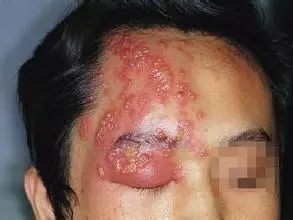 带状疱疹为什么痛不欲生,让人疼痛难忍的带状疱疹