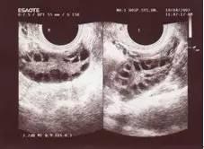 哪些症状提示多囊卵巢综合征?我们该如何诊断?