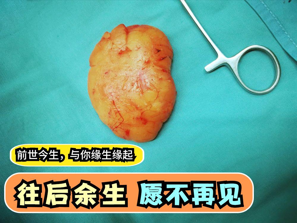 脂肪瘤的案例,脂肪瘤的产生机理