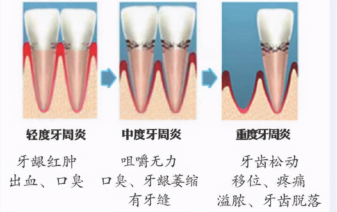 上海牙齿松动怎么修复,牙齿松动修复固齿医院