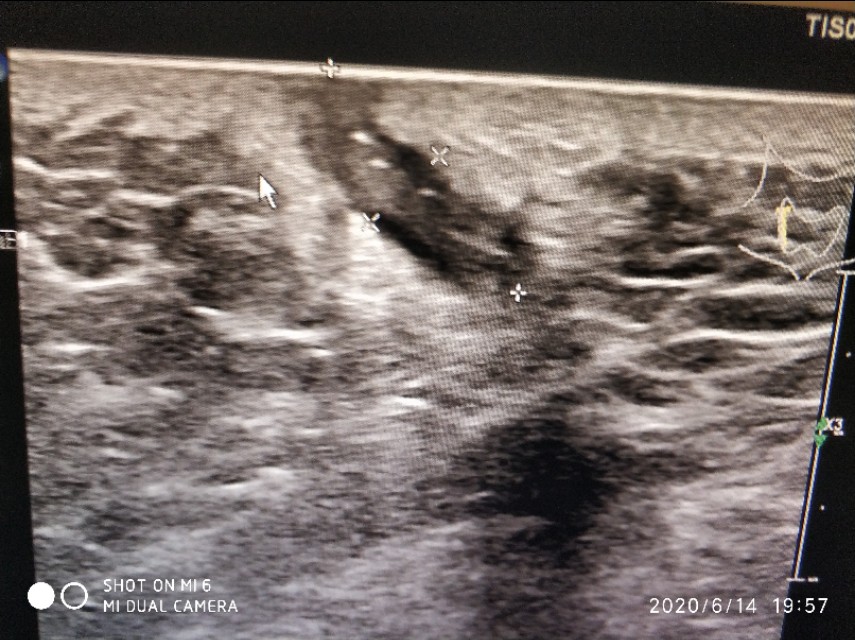 骶尾部硬包就是藏毛窦吗,骶尾骨藏毛窦和囊肿区别