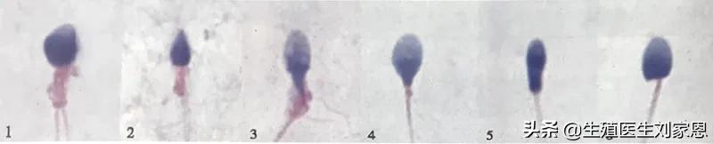 精子畸形率99%胎儿会畸形吗,精子畸形率特别高有什么特效药吗