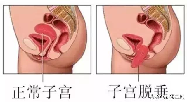 孕妈产后八大疼痛及应对办法！