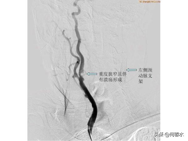 颈动脉狭窄介入治疗,颈动脉狭窄介入手术多少钱
