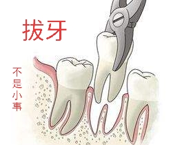 拔牙，就是简单的将牙齿扯出，真是这样吗？|口腔医生：拔牙无小事