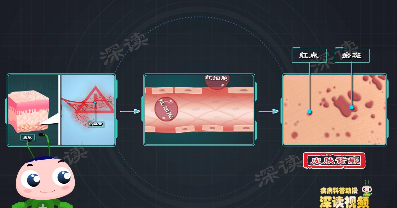 肾性过敏性紫癜多久出现血尿,肾型过敏性紫癜出现血尿时间