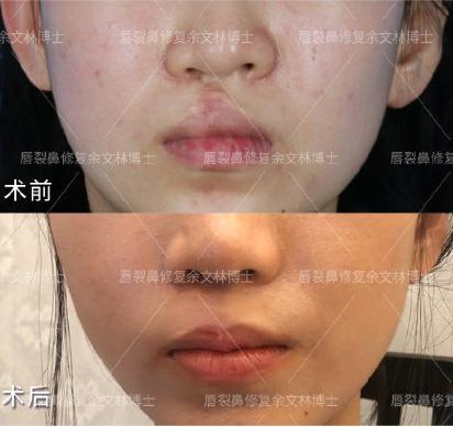 唇裂修复了还有疤痕影响嫁人吗,唇裂伤缝合后会有疤痕吗