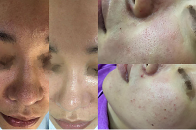 宝露斯毛孔收细套:赋活嫩滑肌肤、收缩毛孔渐平滑