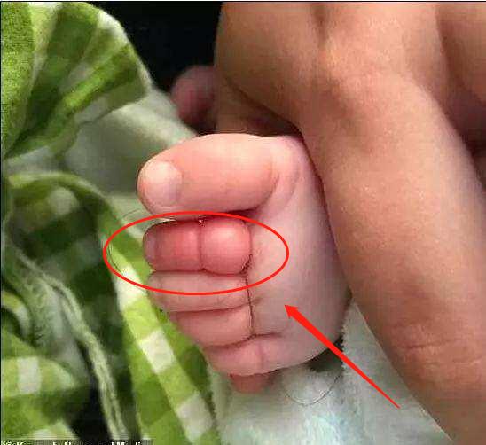 两岁宝宝腿上被虫子咬了肿很大,孩子脚被虫子咬了整个脚肿了图片