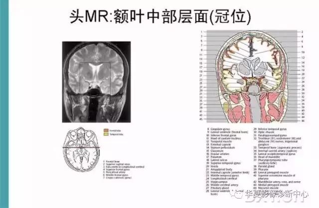 mra头颅解剖学详细讲解视频,常见的头颅mri图像