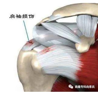 肩袖撕裂能自愈吗,肩袖撕裂康复训练