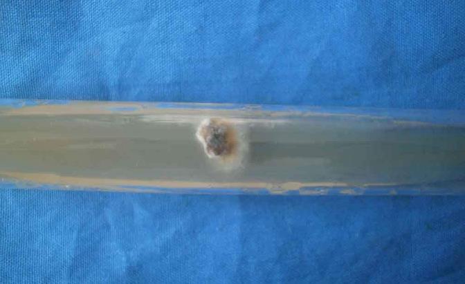 最常见的皮肤癣菌病是哪一种菌,孢子菌感染皮肤病怎样治疗