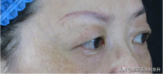 眼皮耷拉除了提眉还有什么办法,眼皮松弛下垂想提眉是需要动刀不