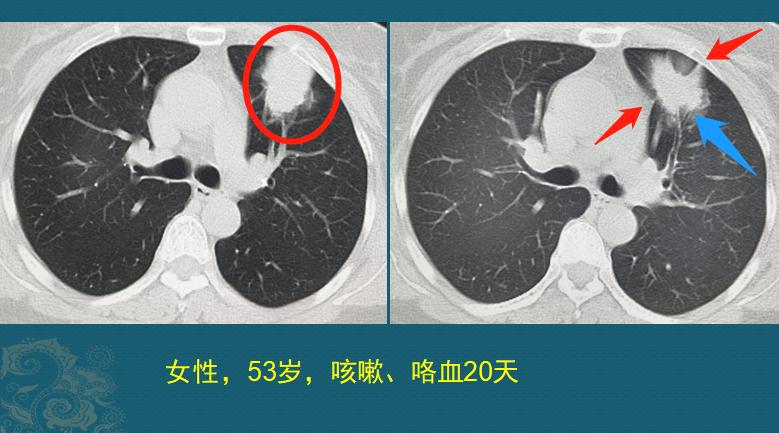 肺癌侵犯胸膜胸腔积液内有癌细胞,中心型肺癌侵犯胸膜疼痛怎么办