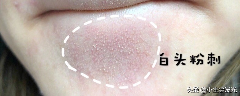 闭口怎么形成的怎么去,闭口一般是怎么形成的