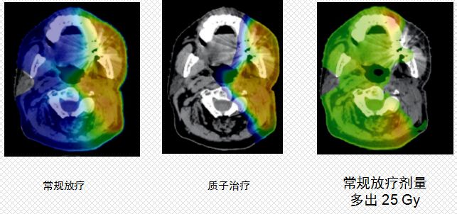 被誉为“抗癌神器”的质子治疗,这几类患者最适合