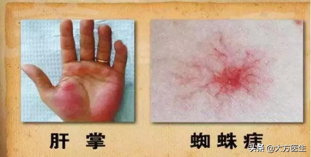 肝病引起的蜘蛛痣代表着什么,警惕这种痣可能是肝硬化