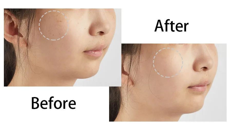 目前为止最温和无伤害的祛斑方法,揭秘有效祛斑方法大爆料