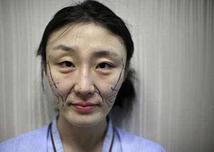 一次脸部微整形换来五年修复路,面部微整形美容前后对比