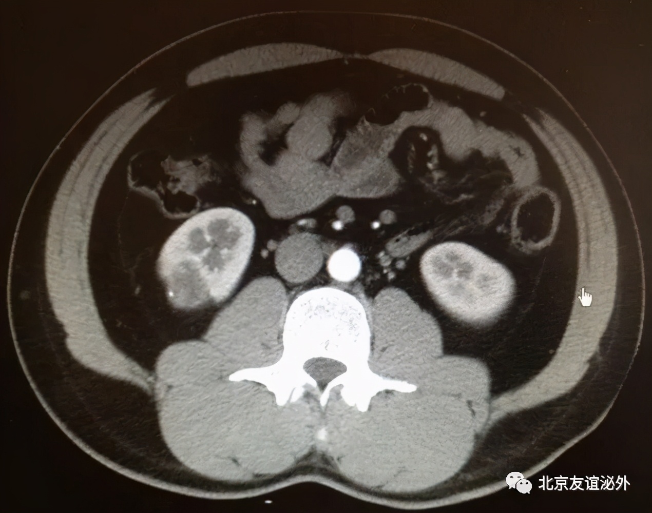体检发现肾囊肿了怎么办?
