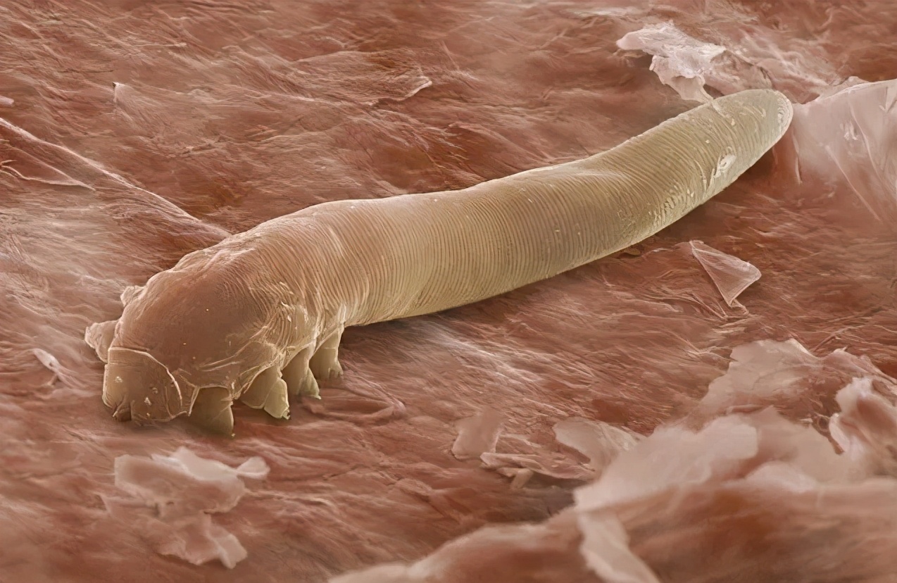 冬天螨虫多还是夏天螨虫多,怎么有效的去除螨虫简单方法