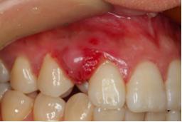 牙龈总是出血吃点什么药最好,牙龈总是一吸或者一舔就出血