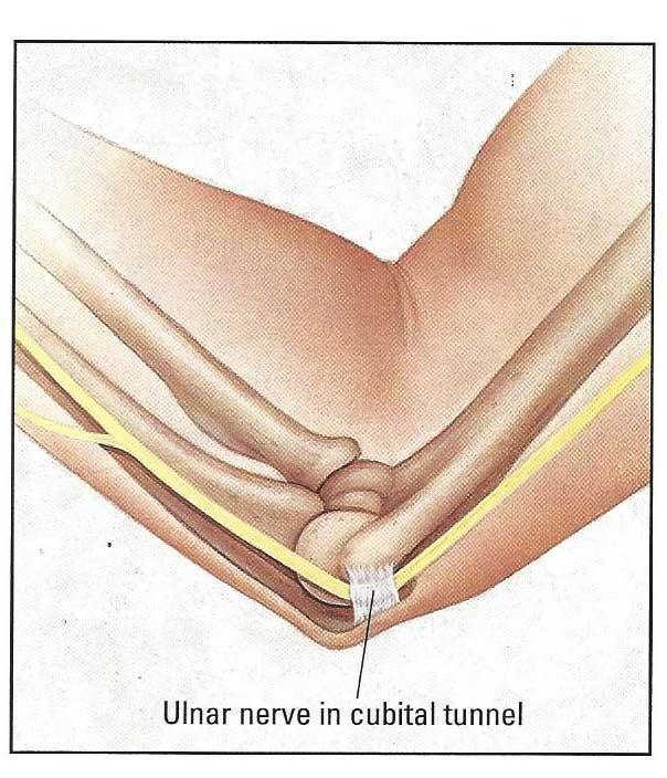 “医生，我胳膊肘伸不直了，还用不了筷子了，我是怎么了啊？”