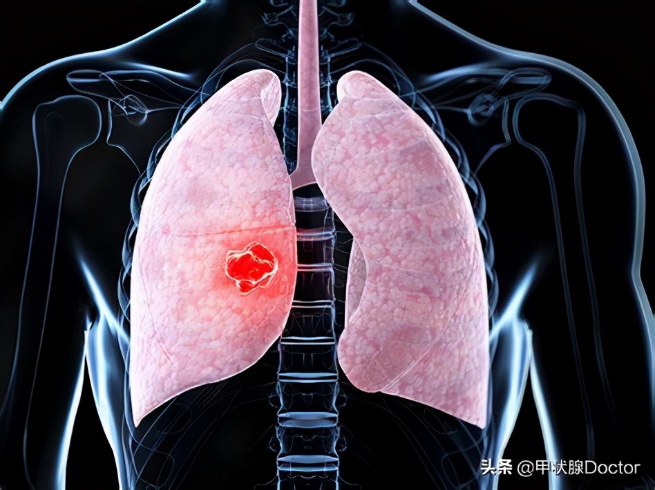 甲癌如何分期？重不重要？一文讲明白甲癌分期