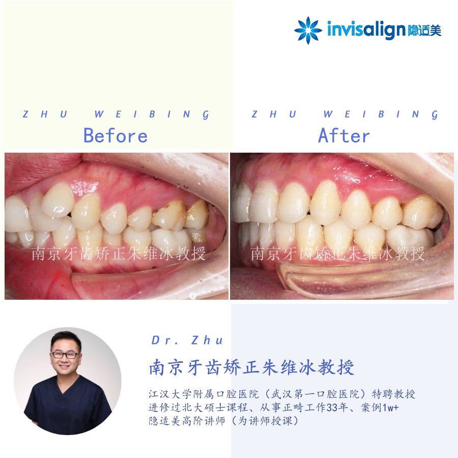 南京口腔医院矫正一颗牙齿多少钱,大医院为啥不建议做牙齿矫正