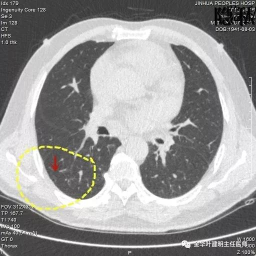 警惕-会是简单的肺大泡吗？
