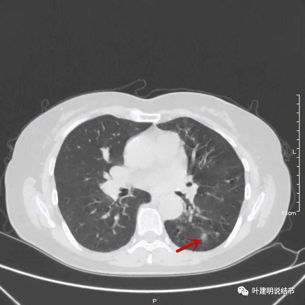 这样的实性结节伴小空洞会是肺癌吗？