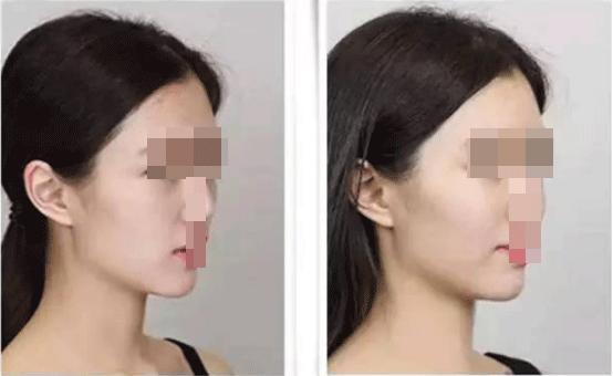 法令纹显老10岁三种方法帮助改善,脸上有法令纹最好解决的办法