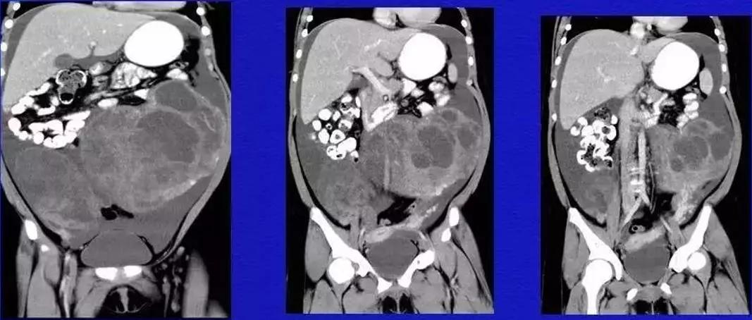 卵巢原发肿瘤的分析思路