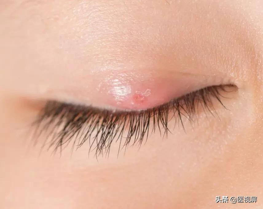 麦粒肿要去医院吗,得了麦粒肿要去学校吗