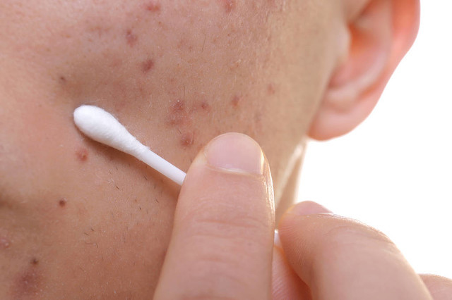 脸上有痘印该如何祛痘印,脸上有痘印怎么弄才能消除