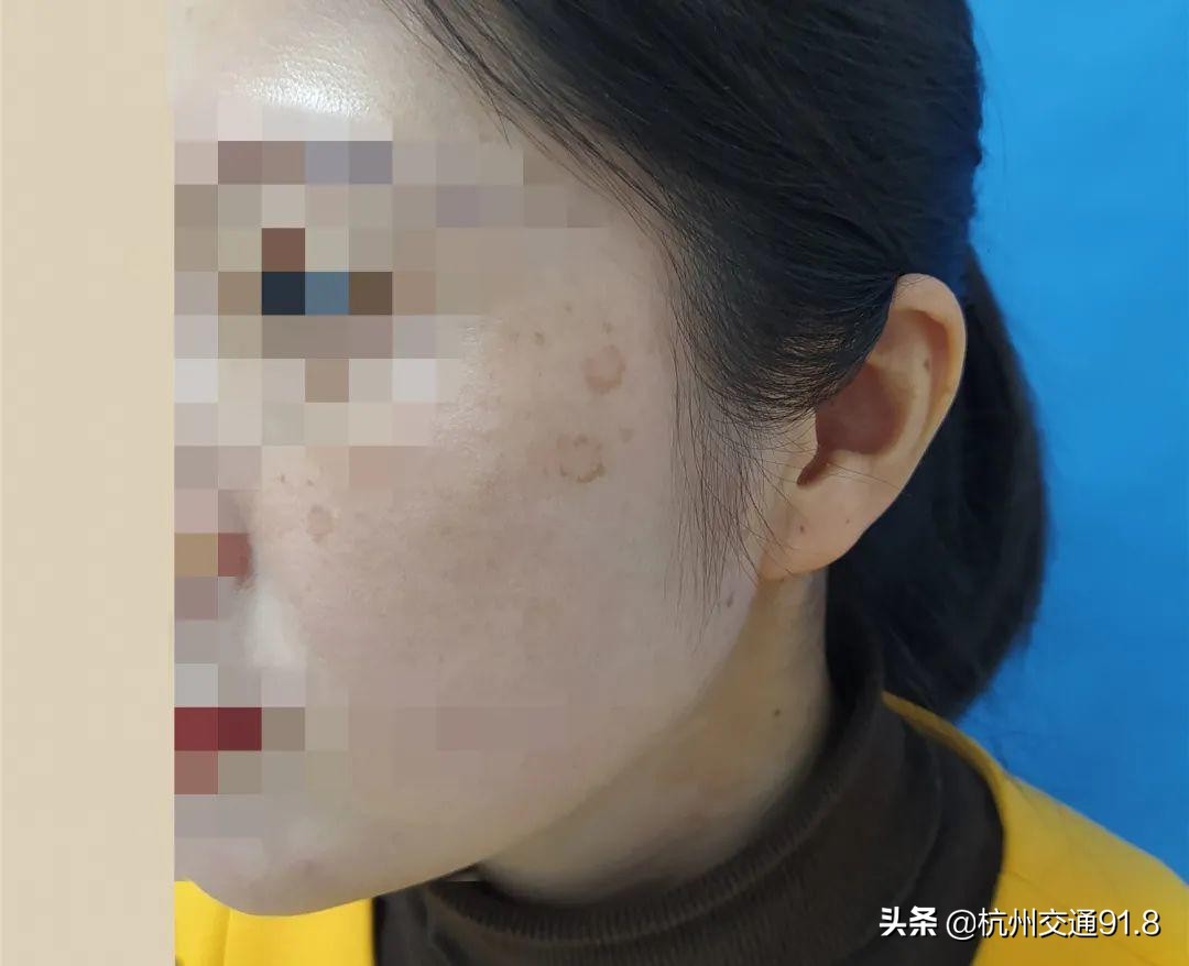 90后姑娘熬夜10年长出老年斑,杭州姑娘熬夜