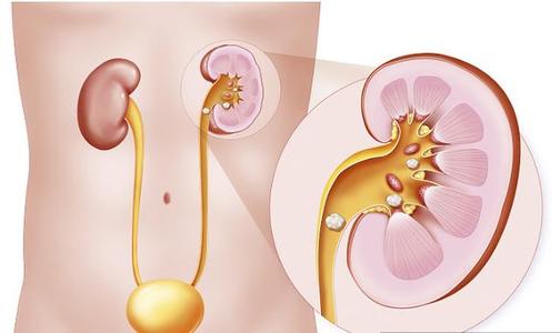 肾结石小好治疗吗,肾结石不痛不痒需不需要治疗