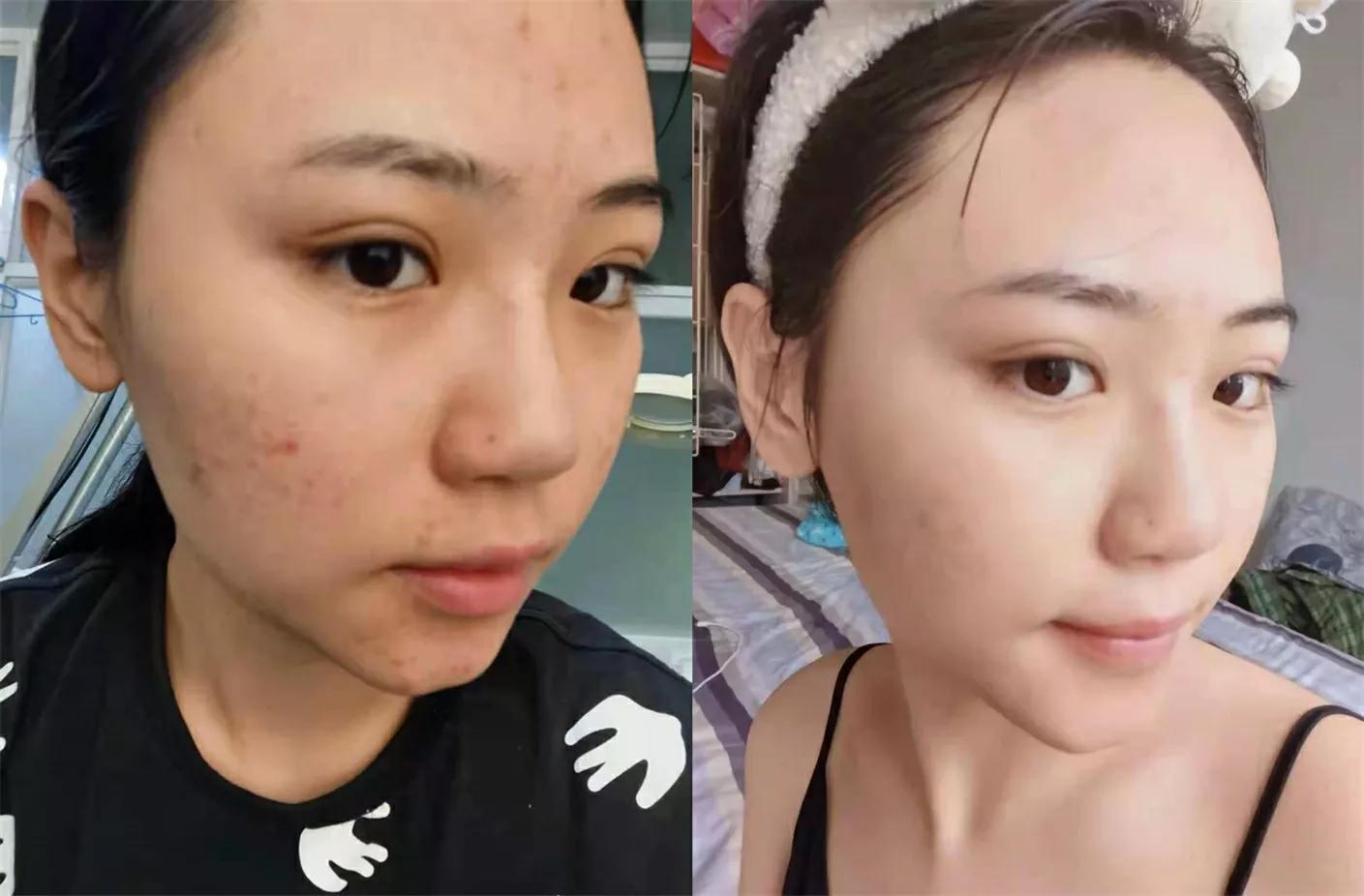 去皮肤科医院看痘痘,北京看痘痘好的皮肤科医院