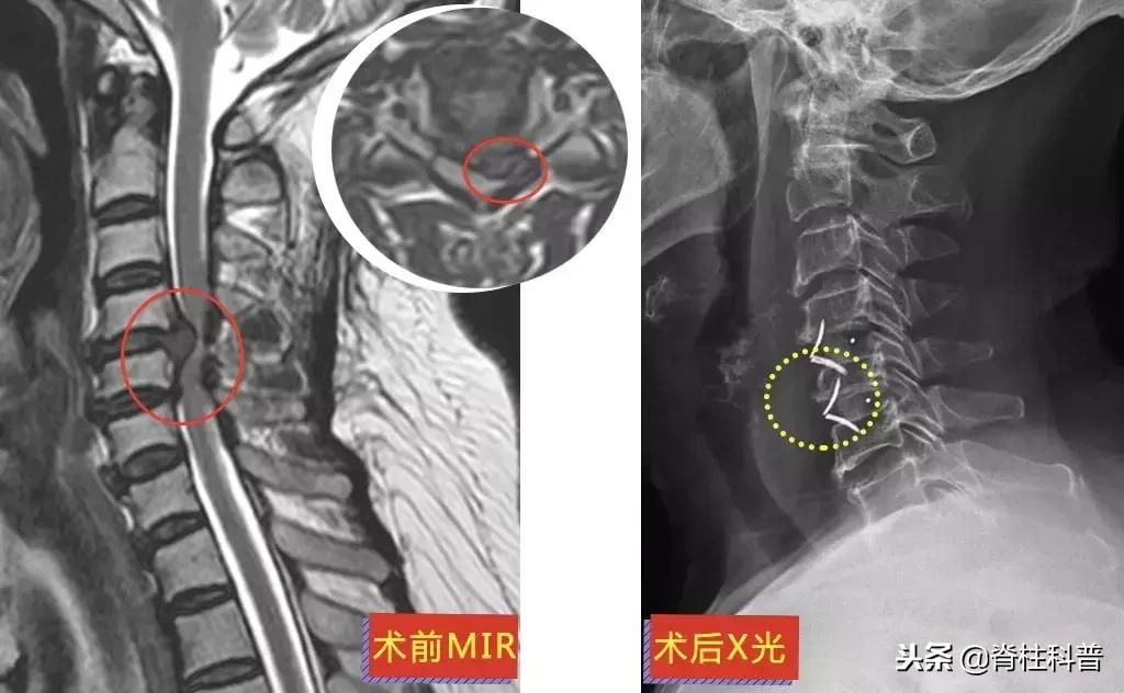 颈椎病治疗的分享,关于颈椎病通俗易懂的科普