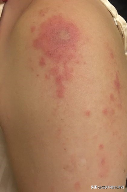 怎么知道隐翅虫皮炎严不严重,怎样能治疗隐翅虫皮炎