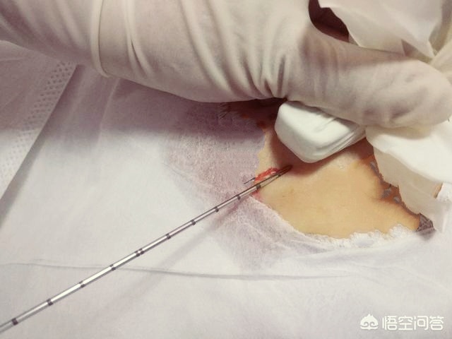 乳房肿块溢血是不是乳腺癌,乳房疼痛乳腺结节是什么情况