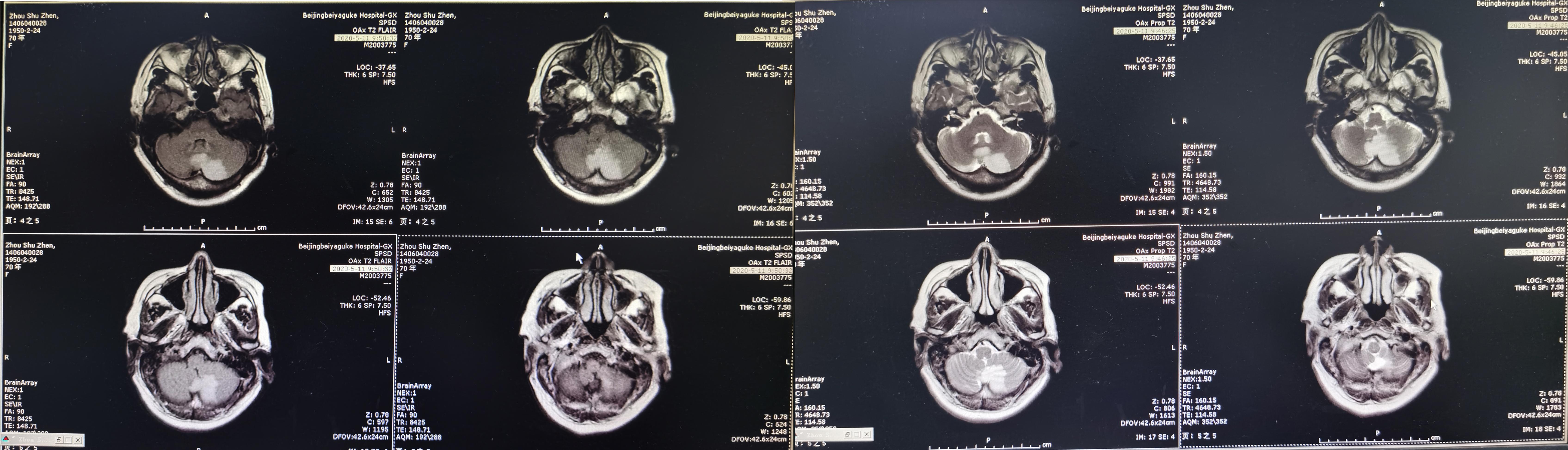 颈椎术后脑脊液漏取什么体位,脊髓型颈椎病手术后植骨愈合时间