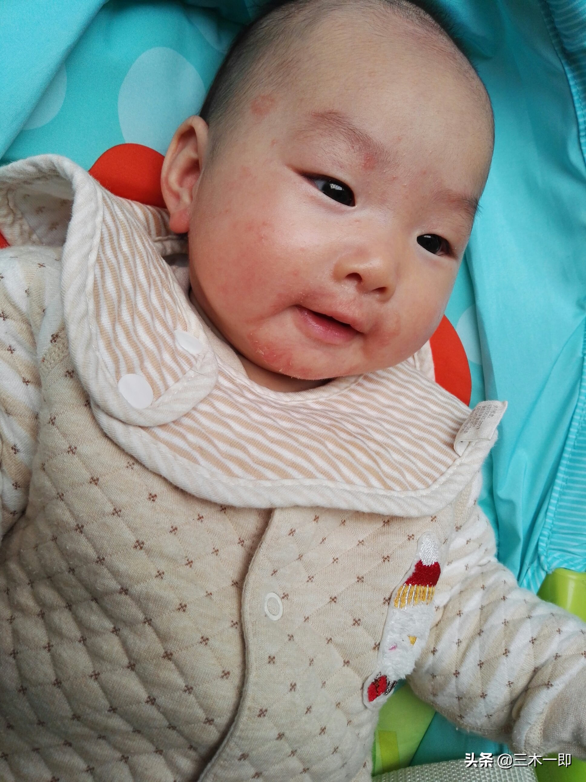 儿童湿疹的治疗做好保湿是关键,湿疹太顽固几招让湿疹不再来