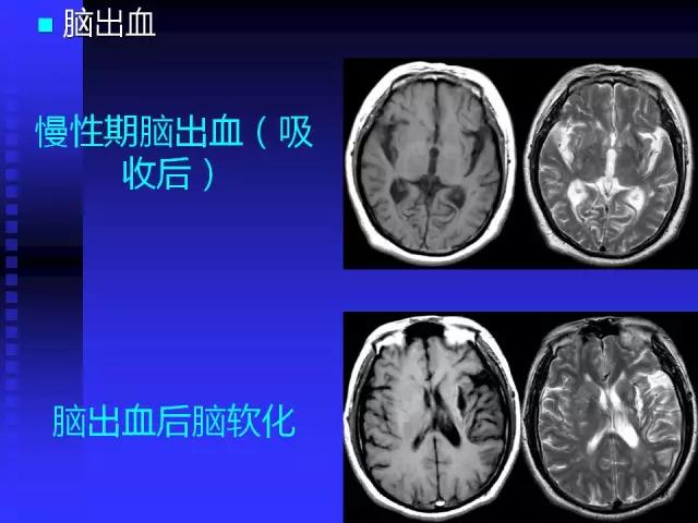 头颅mri读片视频教程,颅脑mri读片入门教程视频讲解全集