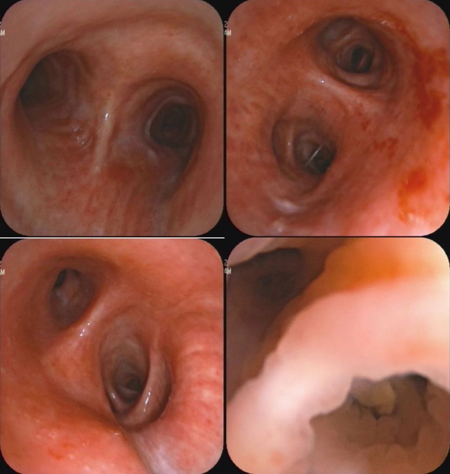慢阻肺患者合并真菌感染,慢阻肺和真菌定植有关系吗