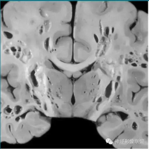 各种囊肿的症状,颅内囊肿18-19mm严重吗