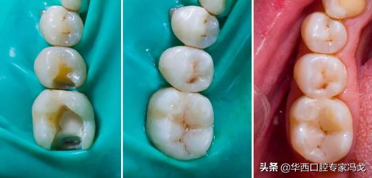 门牙龋坏了建议补牙还是做牙冠,龋坏补牙了还会坏吗