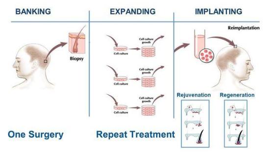 贝克汉姆怎么治疗脱发,贝克汉姆脱发的原因