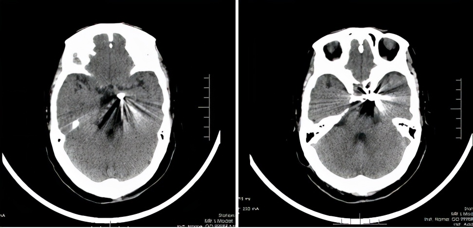 眼皮突然下垂看东西重影,突然大小眼右眼眼皮耷拉